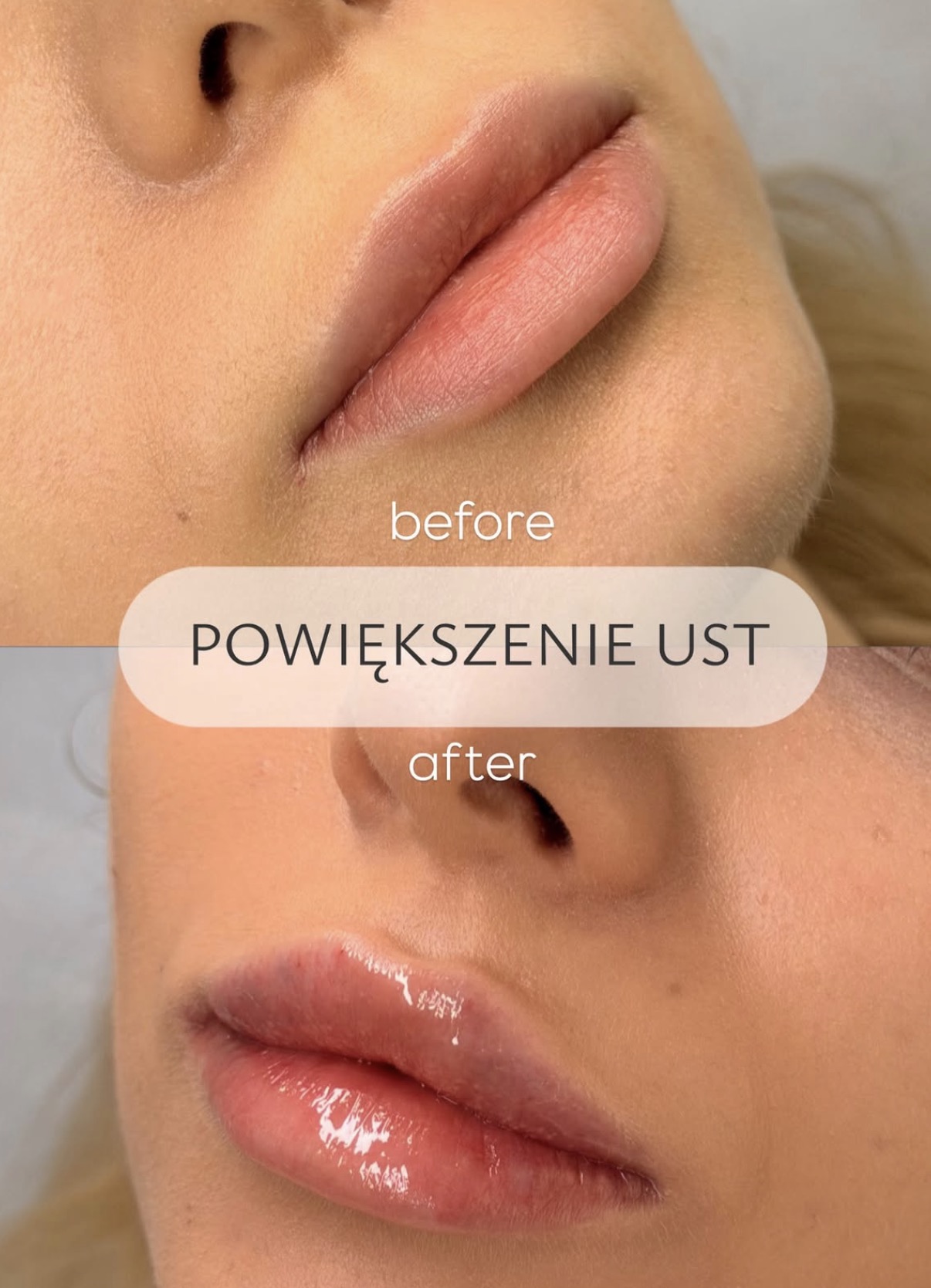 Powiększenie ust — efekt przed i po